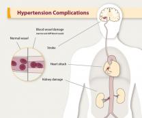 Hypertension complications image showing blood vessel damage compared to a normal vessel. It also shows a stroke, heart attack and kidney damage.